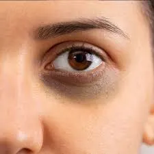 natural remedy for dark circles under eyes – Femin Space tip